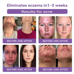 Bostore® hyaluronic acid nano micro-needle regenerating patch image Bostore® hyaluronic acid nano micro-needle regenerating patch