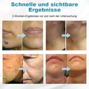 Hermsa® non-invasive laser pointer