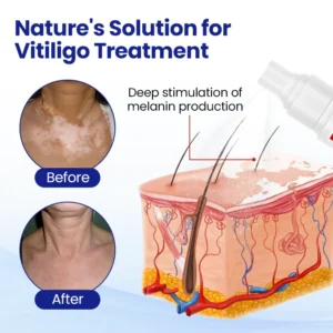 Lovilds® Vitiligo Treatment Spray image Lovilds® Vitiligo Treatment Spray