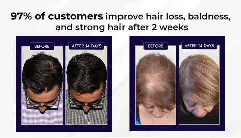 HZA™ Natural Hair Regrowth Spray