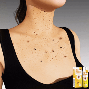 TagRecede™ Bee Venom Treatment Spray