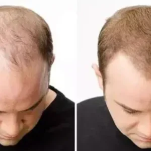 Lovilds® Hair Restoration Spray