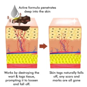LOVILDS™ Warts & Tags Remover Pen image LOVILDS™ Warts & Tags Remover Pen