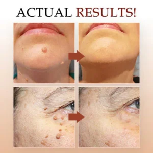 LOVILDS™ Warts & Tags Remover Pen image LOVILDS™ Warts & Tags Remover Pen