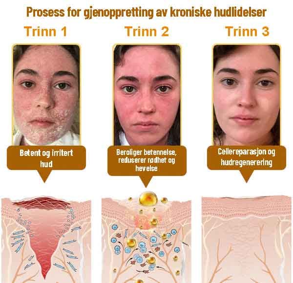 BeeRx™ Skin Cream | Break out of the endless cycle of failed creams, strong steroids and empty promises