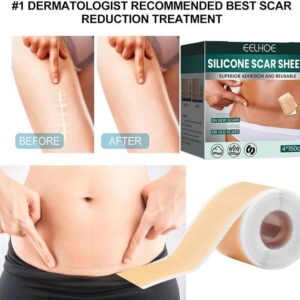EELHOE Silicone Scar Sheets!