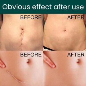 EELHOE Silicone Scar Sheets!