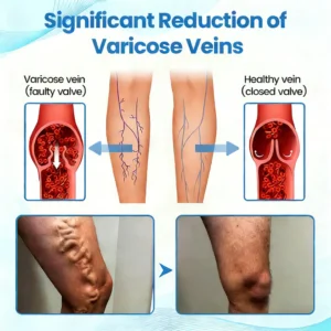 GFOUK® VascuCare Vein Healing Spray