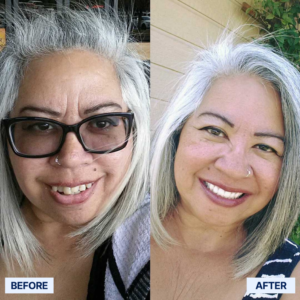 Seurico™ Functional Dentures image Seurico™ Functional Dentures