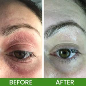 LIMETOW® Herbal Tinea Itching Cream