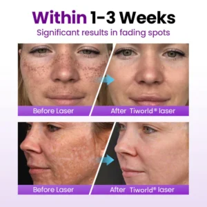 Tiworld® SpotErase Probiotic Shield Serum image Tiworld® SpotErase Probiotic Shield Serum