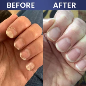 LIMETOW® Nail Repair Solution