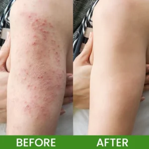 LIMETOW® Herbal Tinea Itching Cream