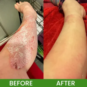 LIMETOW® Herbal Tinea Itching Cream