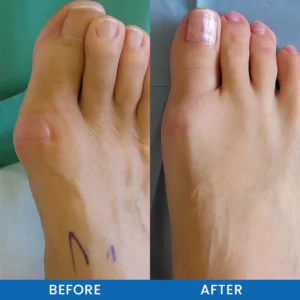 LIMETOW® Bunion-Free Solution
