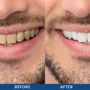 LIMETOW® Teeth Whitening Essence