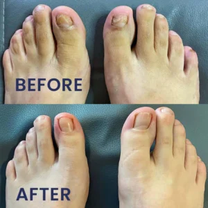 LIMETOW® Nail Repair Solution