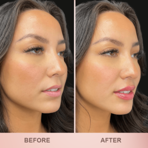 LIMETOW® Lip Plumper Kit image LIMETOW® Lip Plumper Kit