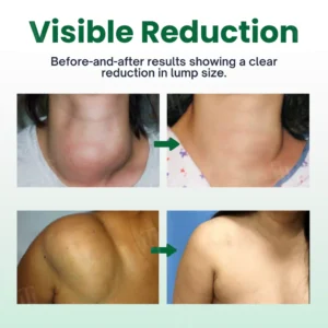 Cvreoz® Knot-X Lipoma Dissolve Cream image Cvreoz® Knot-X Lipoma Dissolve Cream