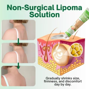 Cvreoz® Knot-X Lipoma Dissolve Cream image Cvreoz® Knot-X Lipoma Dissolve Cream