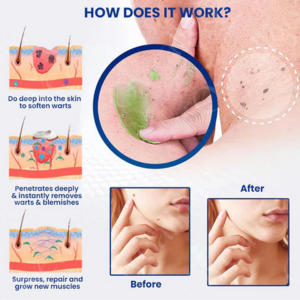 Fivfivgo™ NatureErase Instant Mole & Spot Removal Gel image Fivfivgo™ NatureErase Instant Mole & Spot Removal Gel