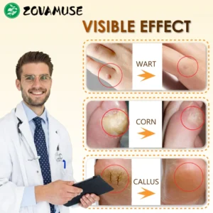 ZOVAMUSE Bee Venom Wart Corn & Callus Remover Cream