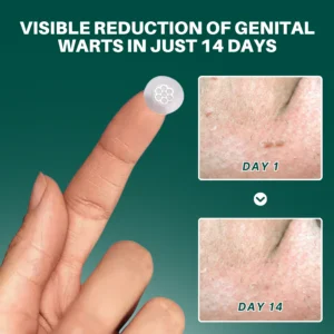 Fivfivgo® Magnesium MicroPin HPV Genital Wart Removal Patch