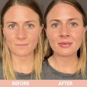 LIMETOW® Lip Plumper Kit image LIMETOW® Lip Plumper Kit