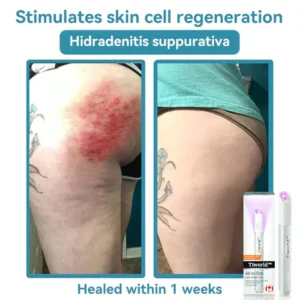 TIWORLD™ All-in-One CO₂ Laser Eraser Pen image TIWORLD™ All-in-One CO₂ Laser Eraser Pen