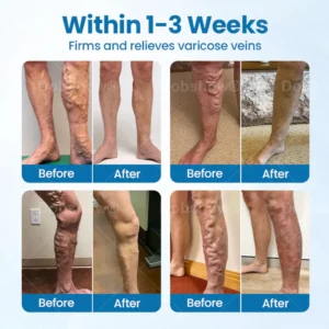 Cvreoz® VeinGuard Herbal Spray