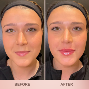 LIMETOW® Lip Plumper Kit image LIMETOW® Lip Plumper Kit