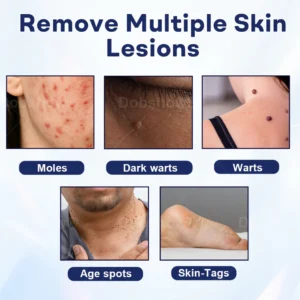 Cvreoz® Mole and Wart Removal Cream image Cvreoz® Mole and Wart Removal Cream