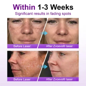 Zvoevo® SpotErase Probiotic Shield Serum image Zvoevo® SpotErase Probiotic Shield Serum