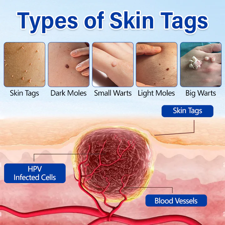 Taileden WartClear Herbal Ointment image Taileden WartClear Herbal Ointment