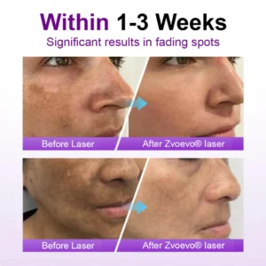 Zvoevo® SpotErase Probiotic Shield Serum image Zvoevo® SpotErase Probiotic Shield Serum