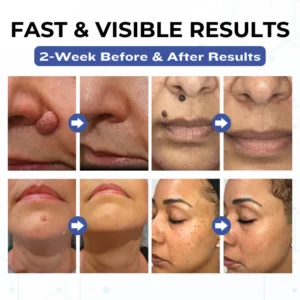 Timilk® VanishPro Skin Spot Removal Cream