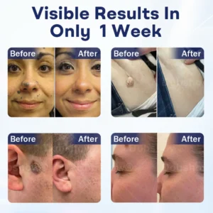 Cvreoz® Mole and Wart Removal Cream image Cvreoz® Mole and Wart Removal Cream