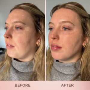 LIMETOW® Lip Plumper Kit image LIMETOW® Lip Plumper Kit