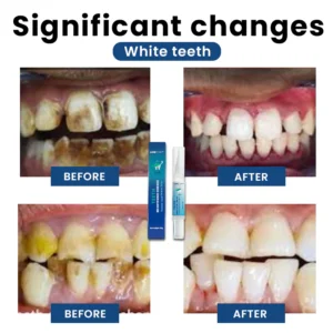 LIMETOW® Teeth Whitening Essence