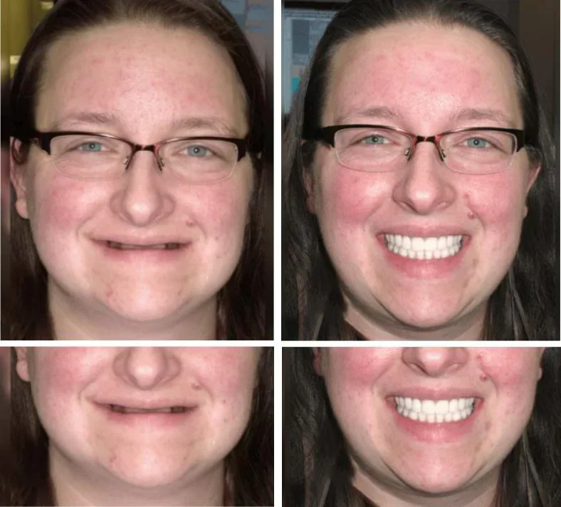 Custom-SET Functional Dentures