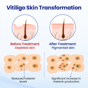 KUBOZN® Vitiligo Repigmentation Spray