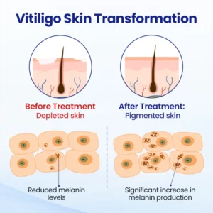 YAGOO® Vitiligo Treatment Spray image YAGOO® Vitiligo Treatment Spray