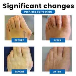 LIMETOW® Bunion-Free Solution