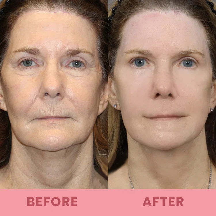 LIMETOW™ Compact Anti-wrinkle Bar image LIMETOW™ Compact Anti-wrinkle Bar