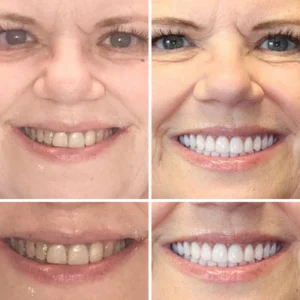 Yagoo™ Advanced Customized Full Denture Set image Yagoo™ Advanced Customized Full Denture Set