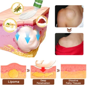 Tiworld™ LipomaCure Soothing Ointment image Tiworld™ LipomaCure Soothing Ointment