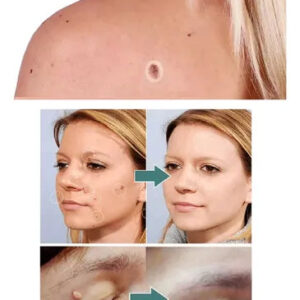 FORMU CLEAR™ Painless Wart-Free Skin! 216 Patches!