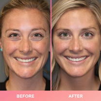 LIMETOW™ Compact Anti-wrinkle Bar image LIMETOW™ Compact Anti-wrinkle Bar