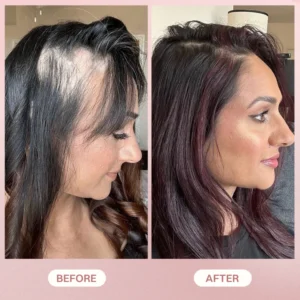 LIMETOW® H-Regrow 2.0