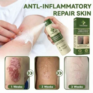 TAILEDEN Magnesium Herbal Psoriasis Spray
